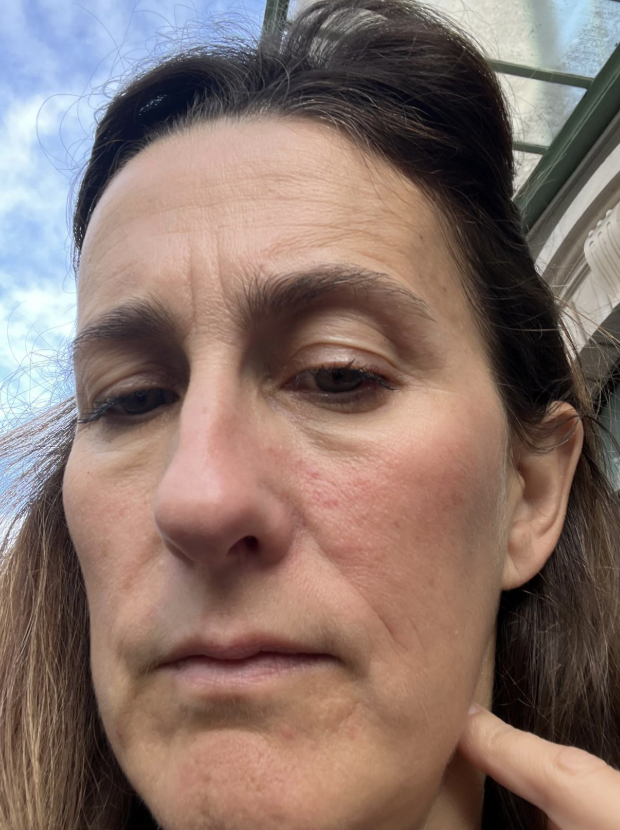 Mélanie avant traitement